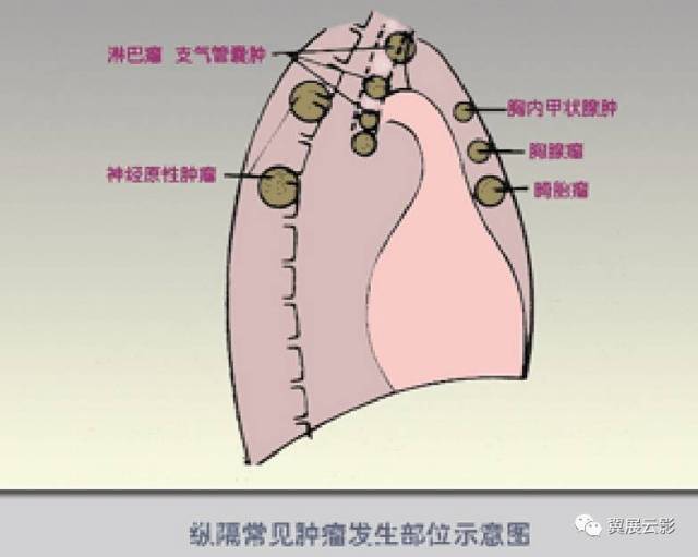 详解纵隔肿瘤以及鉴别诊断