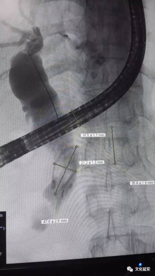 原创延大附院消化内科采用ercp术为患者取出胆总管巨大结石