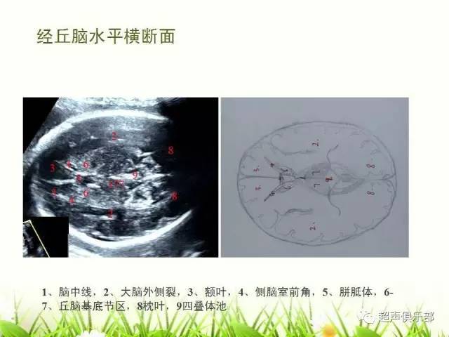 【图示 手绘】读懂正常胎儿颅脑超声