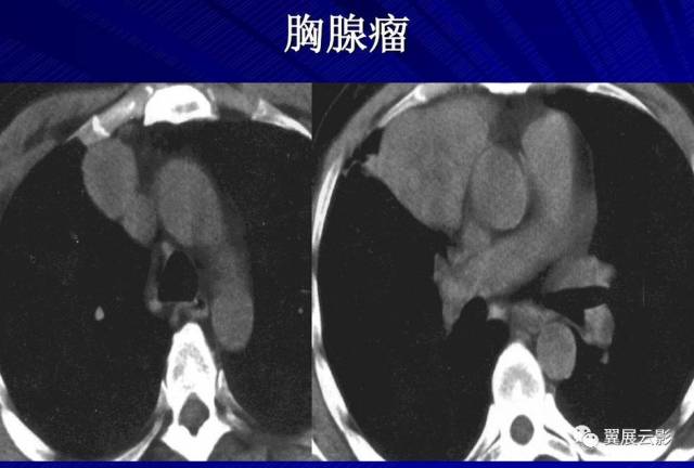 详解纵隔肿瘤以及鉴别诊断