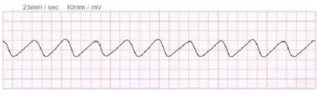 (2)qrs-t 波融合,形成典型的高血钾正弦波形