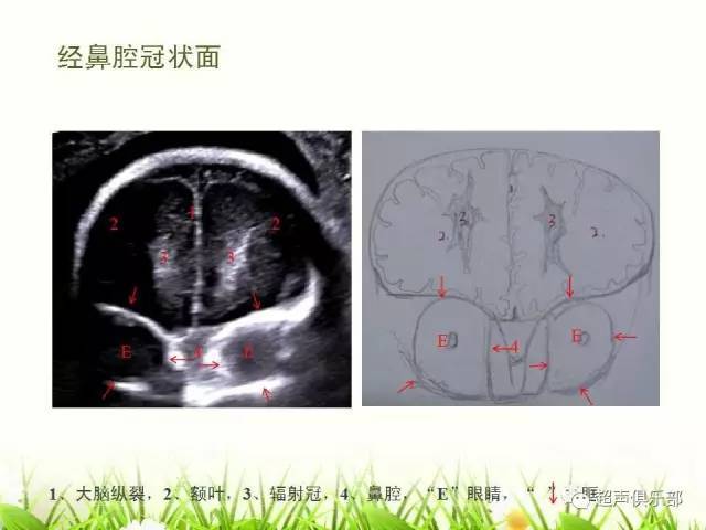 【图示 手绘】读懂正常胎儿颅脑超声