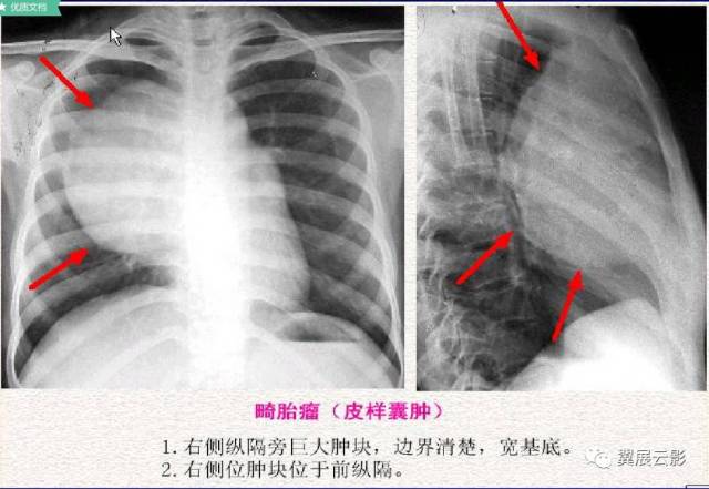 详解纵隔肿瘤以及鉴别诊断