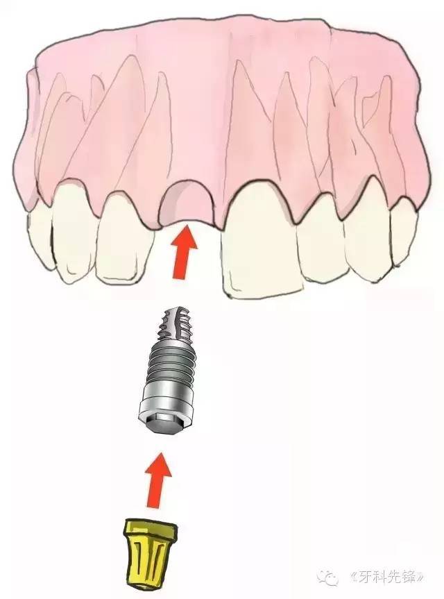 1,单颗牙缺失缺牙的种植修复方法在我们身边总会有几个缺牙的朋友