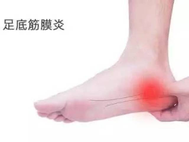 足底筋膜炎(足痛)的康复治疗