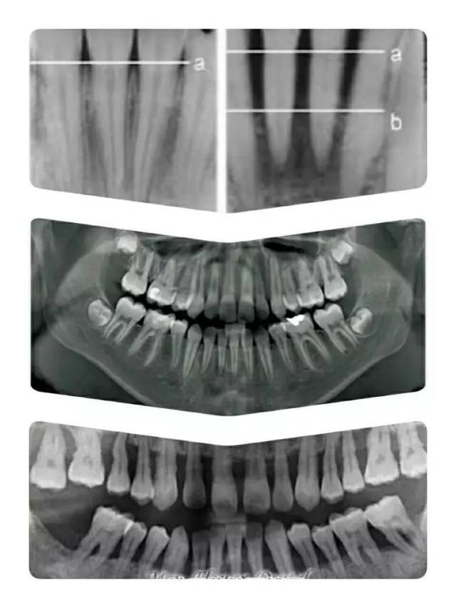 a 线萎缩到了b 线(中图为正常全口x光牙片,最下图为全口重度牙周病x光