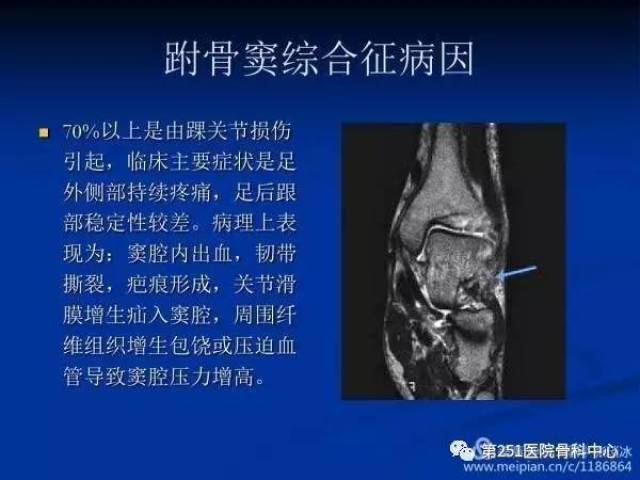 八 跗骨窦综合征 附骨窦区 跗骨窦综合征指踝扭伤后跗骨窦的持续性