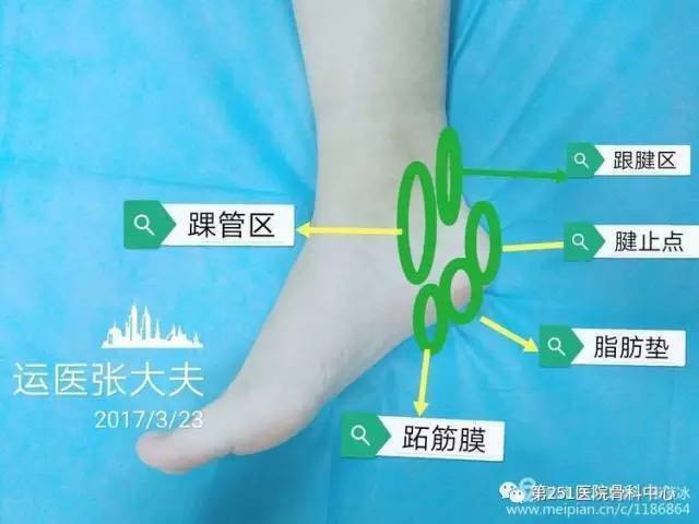 外侧面 足跟痛常见以下几类:1,跖筋膜炎;2,跟下脂肪垫炎;3,跟腱末端