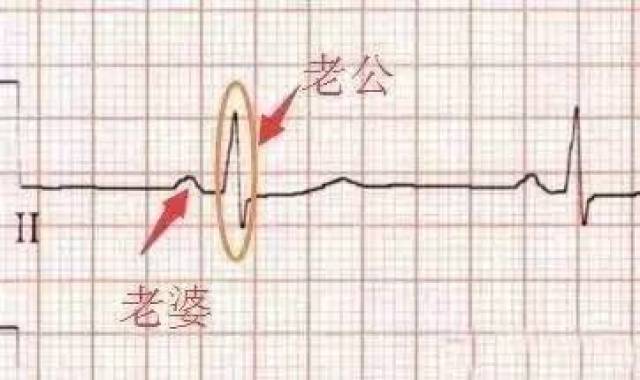 这样教你看心电图,还有什么理由不会?-搞笑频道-手机