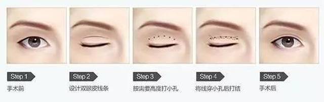 埋线法重睑成形术,手术引起的瘢痕较小,解剖构造改变不大,故矫正过宽