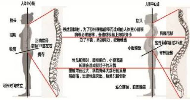 骨盆前倾的自查自治!
