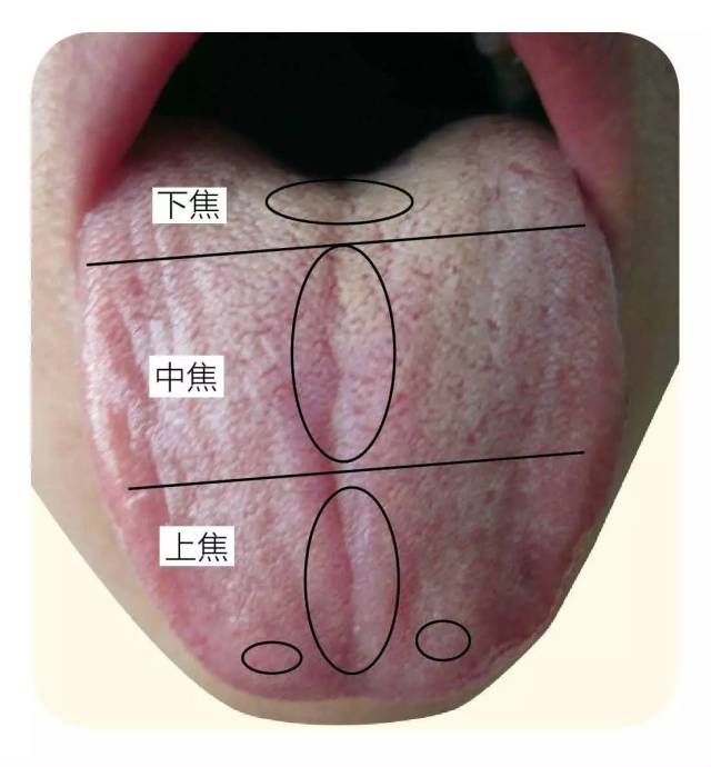 慢性咽炎——舌尖中部为咽喉; 2.