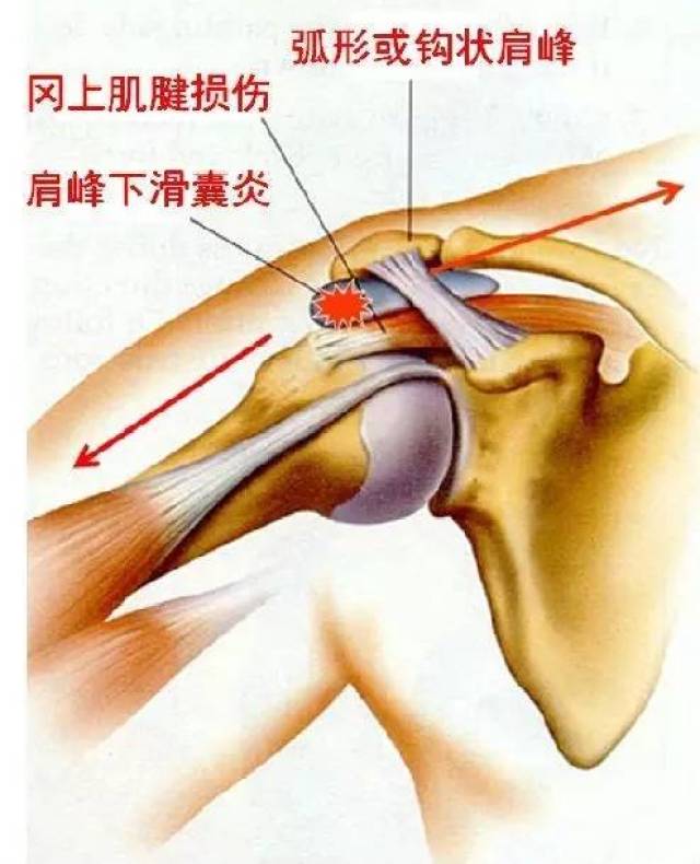 肩峰下撞击症