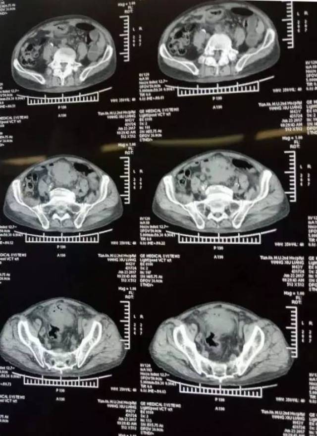 【医疗动态】医大二院肛肠外科成功进行复杂性难治性结肠癌手术_手机