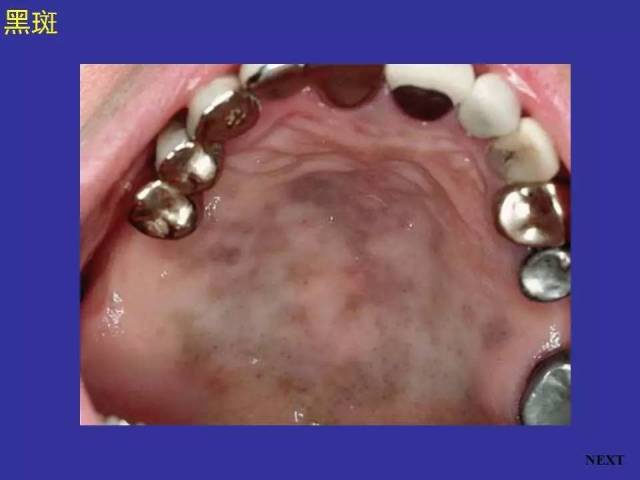 多图连载(一):正常口腔黏膜及常见病损图