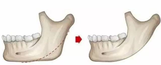 矫正牙齿改变的是牙齿咬合高度,而牙齿的咬合高度直接影响面下三分之