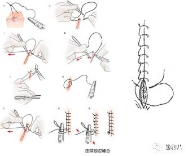 临行密密缝—不同缝合方法特点和适用条件(上 一页手册 协和八