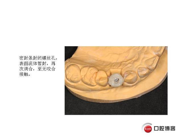 种植后临时牙的制作