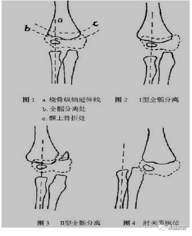 【急诊】骨骺损伤的分型及影像表现