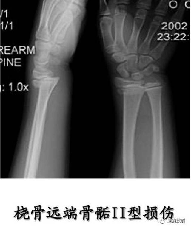 【急诊】骨骺损伤的分型及影像表现