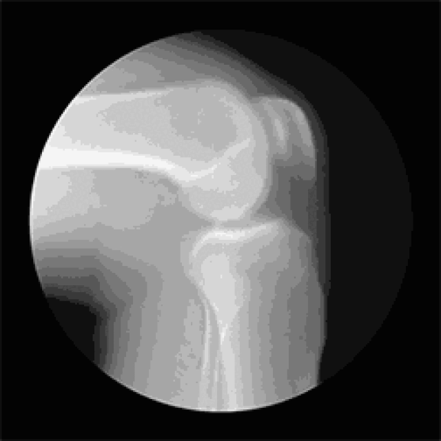 正常情况下,膝盖骨(髌骨)是随着腿的伸张而在胫骨上的轨道里上下滑动