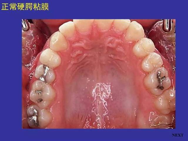 多图连载(一):正常口腔黏膜及常见病损图