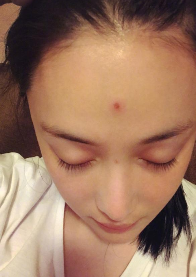 张馨予晒额头长痘照 笑称自己开"天眼"