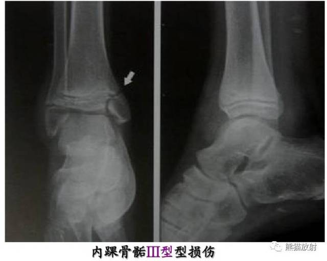 【急诊】骨骺损伤的分型及影像表现