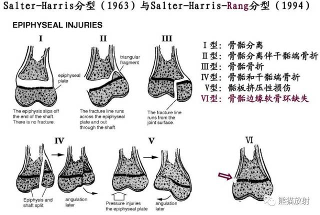 【急诊】骨骺损伤的分型及影像表现