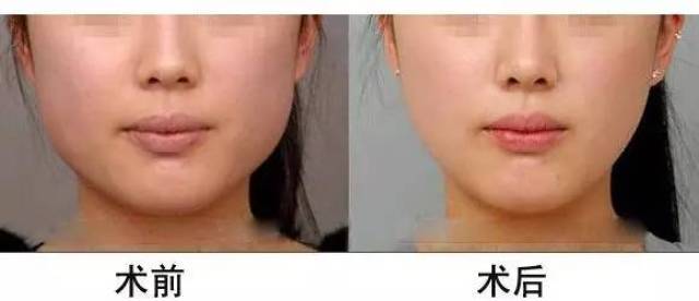 【美立方·微整篇】瘦脸针打了一个多月,脸反而大了?为什么?