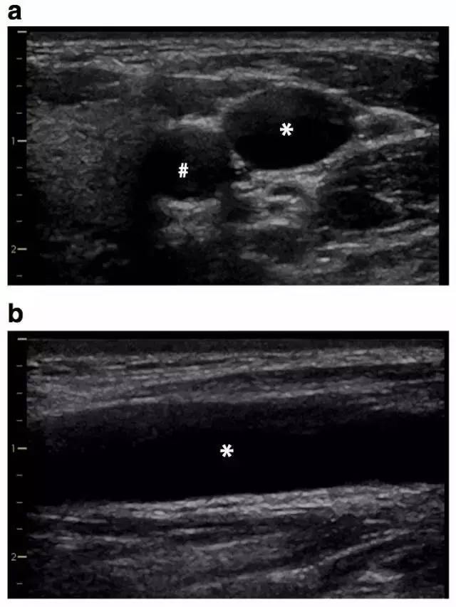(a)短轴切面和(b)长轴切面确定境内静脉(*)及相邻的颈动脉(#)
