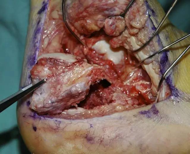 3-a 用组织钳移除较薄的跟骨侧方皮质