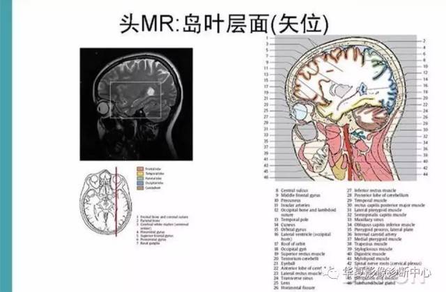 完整的头颅mri解剖 ,值得收藏!