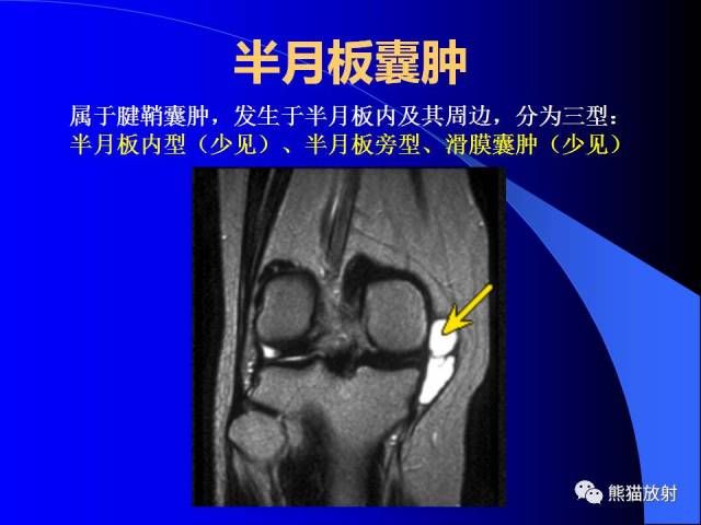 【专家讲座】膝关节周围囊肿mri表现(林祥涛)