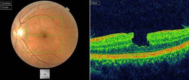 全层黄斑裂孔眼底彩照与oct图像