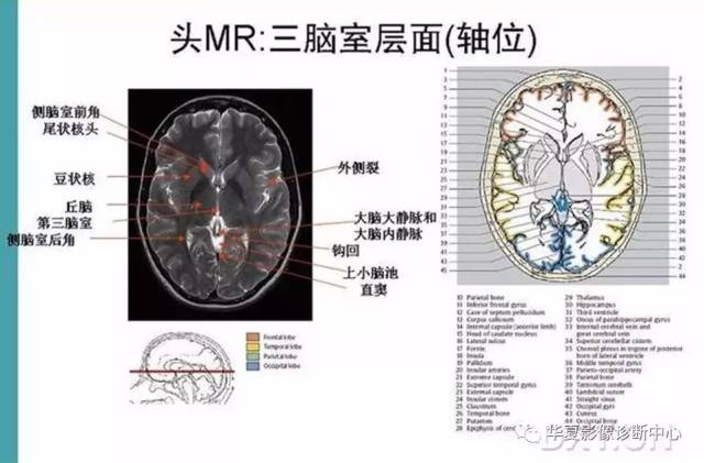 完整的头颅mri解剖 ,值得收藏!