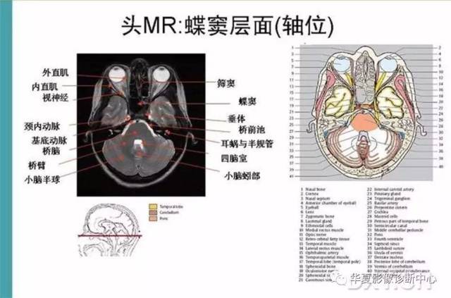 完整的头颅mri解剖 ,值得收藏!