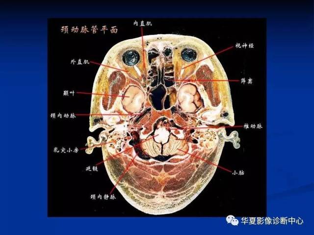 完整的头颅mri解剖 ,值得收藏!