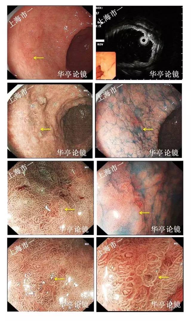 检胃镜(me-nbi eus)