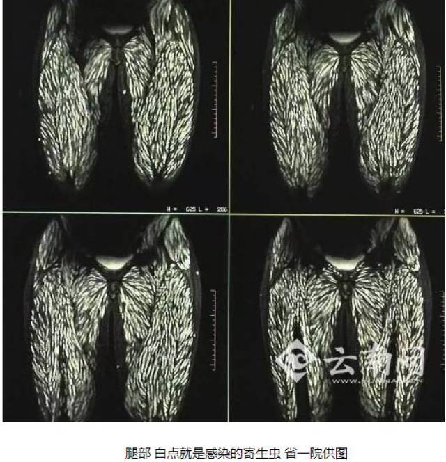 12岁女孩脑袋里被挖了多条"隧道,取出25厘米寄生虫!太吓人了.