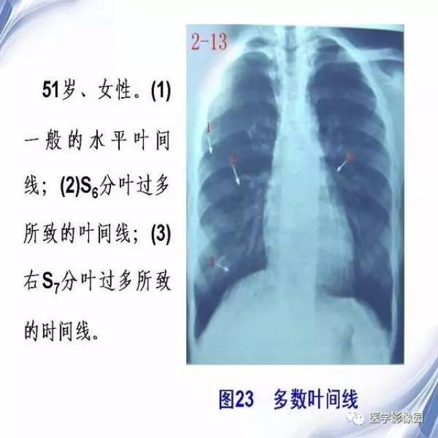 小儿正常非标准胸片的特点丨影像天地