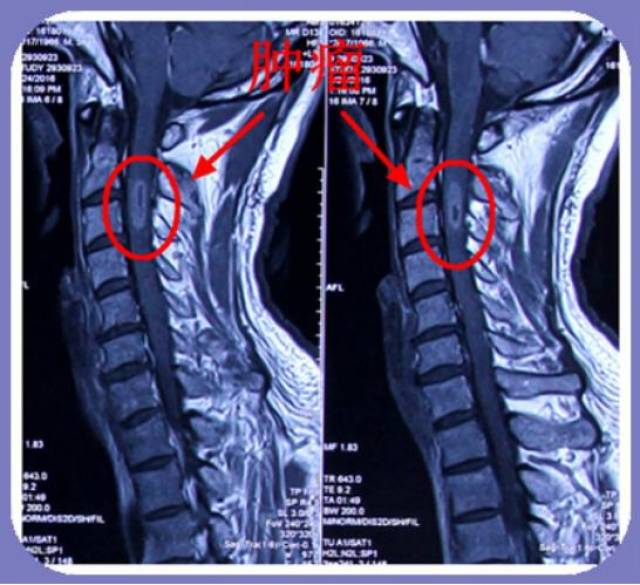 病例:高颈段椎管内星形细胞瘤一例