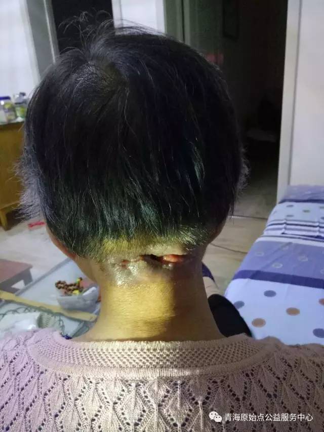 原始点处理头部脓疮案例-后期疮口恢复