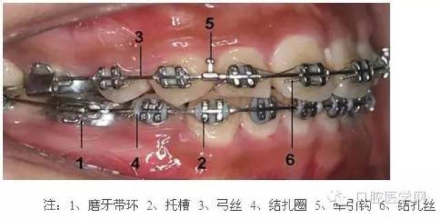 牙齿矫正科普帖:正畸牙套装置部件详解