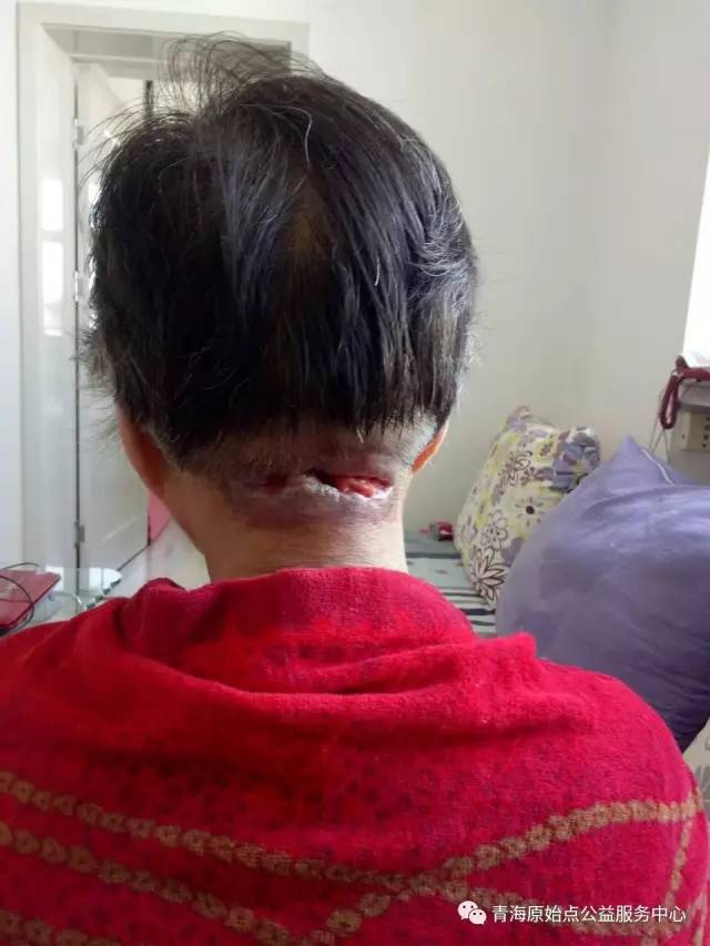 原始点处理头部脓疮案例-后期疮口恢复