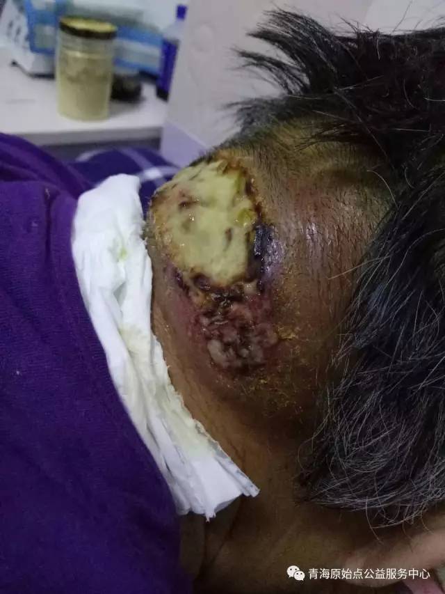 原始点处理头部脓疮案例-后期疮口恢复