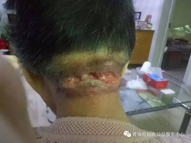 原始点处理头部脓疮案例-后期疮口恢复