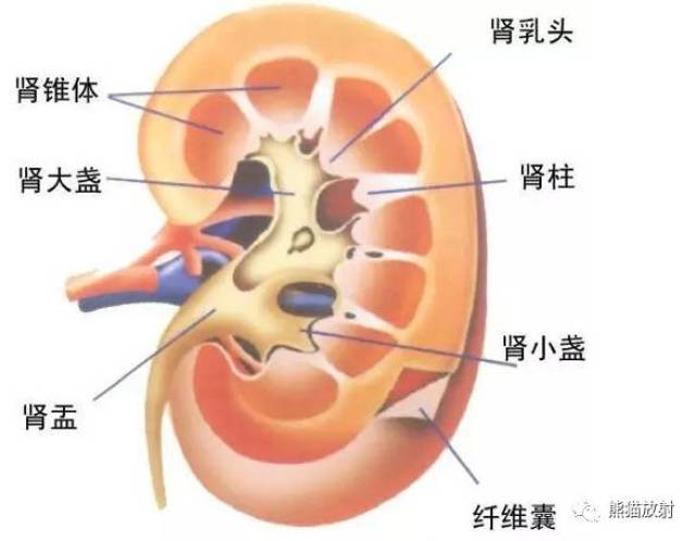 【双语病例】髓质海绵肾(ivp,ct) 鉴别诊断