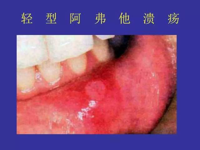 多图连载(二:口腔黏膜感染性疾病及溃疡类疾病图示