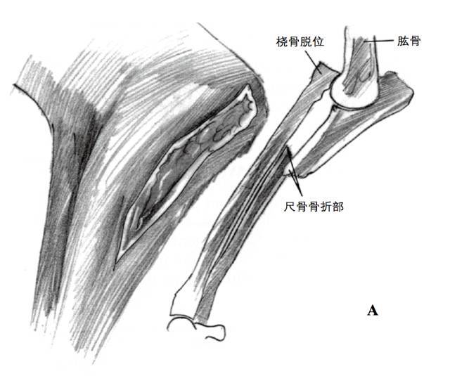 可通过环状韧带修复进行,或者用钢丝或拉力螺钉将桡骨头固定在尺骨上